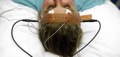 Ect Electroconvulsive Therapy